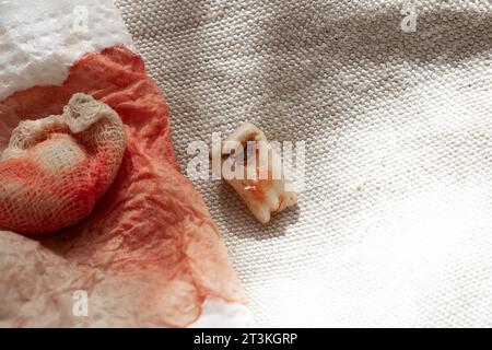 Ein extrahierter Zahn mit einem schwarzen Loch in der Mitte des Zahnes, Nahaufnahme vor dem Hintergrund einer Bandage mit Blut, ein kranker Zahn nach Extraktion Stockfoto