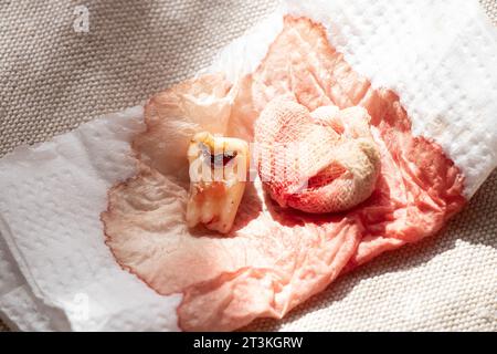 Ein extrahierter Zahn mit einem schwarzen Loch in der Mitte des Zahnes, Nahaufnahme vor dem Hintergrund einer Bandage mit Blut, ein kranker Zahn nach Extraktion Stockfoto