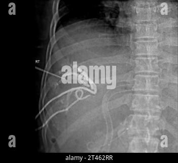 Die perkutane transhepatische Gallendrainage (PTBD) ist ein medizinisches Verfahren zur Behandlung von Gallengangsblockaden. Stockfoto