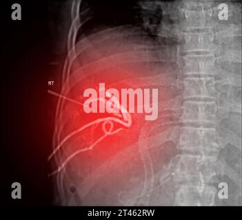 Die perkutane transhepatische Gallendrainage (PTBD) ist ein medizinisches Verfahren zur Behandlung von Gallengangsblockaden. Stockfoto