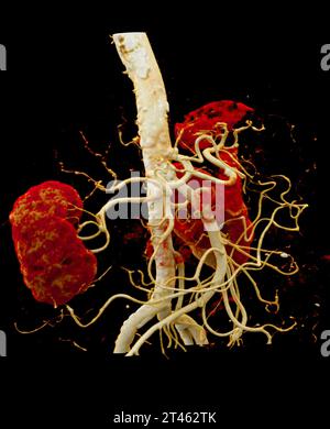 CTA Nierenarterie ist ein medizinisches bildgebendes Verfahren mit CT-Scans zur Untersuchung der Nierenarterien. Es liefert detaillierte Bilder der Blutgefäße Supplyin Stockfoto