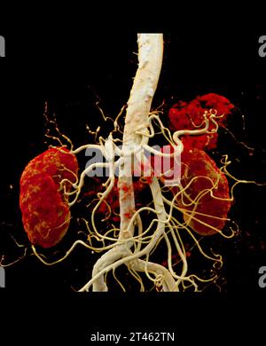 CTA Nierenarterie ist ein medizinisches bildgebendes Verfahren mit CT-Scans zur Untersuchung der Nierenarterien. Es liefert detaillierte Bilder der Blutgefäße Supplyin Stockfoto