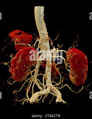 CTA Nierenarterie ist ein medizinisches bildgebendes Verfahren mit CT-Scans zur Untersuchung der Nierenarterien. Es liefert detaillierte Bilder der Blutgefäße Supplyin Stockfoto