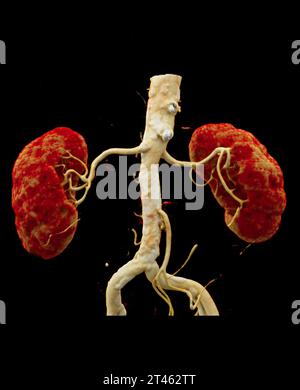 CTA Nierenarterie ist ein medizinisches bildgebendes Verfahren mit CT-Scans zur Untersuchung der Nierenarterien. Es liefert detaillierte Bilder der Blutgefäße Supplyin Stockfoto