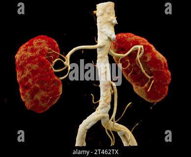 CTA Nierenarterie ist ein medizinisches bildgebendes Verfahren mit CT-Scans zur Untersuchung der Nierenarterien. Es liefert detaillierte Bilder der Blutgefäße Supplyin Stockfoto