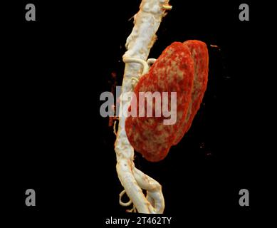 CTA Nierenarterie ist ein medizinisches bildgebendes Verfahren mit CT-Scans zur Untersuchung der Nierenarterien. Es liefert detaillierte Bilder der Blutgefäße Supplyin Stockfoto