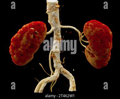 CTA Nierenarterie ist ein medizinisches bildgebendes Verfahren mit CT-Scans zur Untersuchung der Nierenarterien. Es liefert detaillierte Bilder der Blutgefäße Supplyin Stockfoto