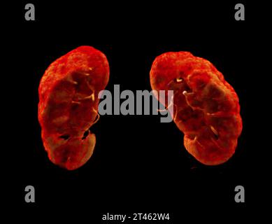 CTA Nierenarterie ist ein medizinisches bildgebendes Verfahren mit CT-Scans zur Untersuchung der Nierenarterien. Es liefert detaillierte Bilder der Blutgefäße Supplyin Stockfoto