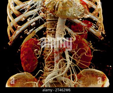 CTA Nierenarterie ist ein medizinisches bildgebendes Verfahren mit CT-Scans zur Untersuchung der Nierenarterien. Es liefert detaillierte Bilder der Blutgefäße Supplyin Stockfoto