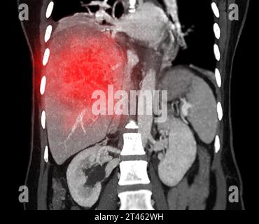 Koronale CT-Ansicht des oberen Abdomens, die zeigt, dass DDX ein atypisches HCC oder ein hepatozelluläres Karzinom ist. Stockfoto