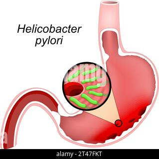 Querschnitt eines menschlichen Magens mit Ulzera. Nahaufnahme von Bakterien Helicobacter pylori, die Magengeschwüre verursachen. Peptische Ulzera. Vektorabbildung Stock Vektor