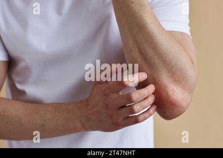 Nahaufnahme eines Mannes, der den Ellenbogen kratzt, an Hautausschlag oder Hautzustand leidet, Kopierraum Stockfoto