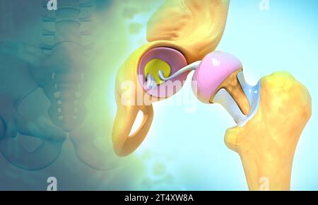 Hüftgelenksersatz im Beckenknochen. 3D-Abbildung Stockfoto