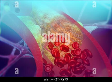 Cholesterinblockierende Arteria. 3D-Abbildung Stockfoto