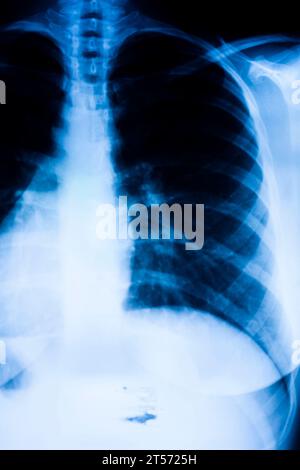 Ergebnis des Röntgenscans der Lungenrippen. Stockfoto