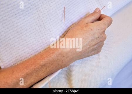 Nadeln an Akupunktur-Uteruspunkten einer Frauenhand während einer traditionellen chinesischen Fertilitätsbehandlung Stockfoto