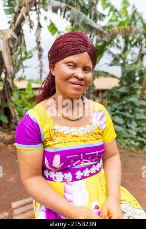 Porträt einer lächelnden jungen afrikanischen Albino-Frau, die draußen auf einem Stuhl sitzt. Stockfoto