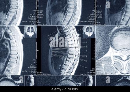 MRT-Untersuchung der Brustwirbelsäule zur Diagnostik. Ärztliche Untersuchung zur Krankheitsprophylaxe. Stockfoto