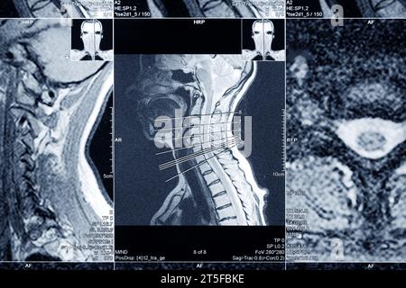 MRT-Untersuchung der Halswirbelsäule zur Diagnostik. Ärztliche Untersuchung zur Krankheitsprophylaxe. Stockfoto