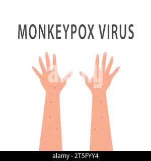 Symptome von Monkeypox.Monkeypox Virus zoonotische Viruserkrankung, die menschliche, nichtmenschliche Primaten infizieren kann. Affenpocken. Vektorabbildung Stock Vektor