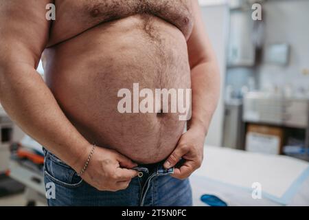 Nahaufnahme des Abdomens eines übergewichtigen Patienten. Hoher Taillenumfang des adipösen Mannes, Bauchfett. Das Konzept der gesundheitlichen Risiken von Uberwight und Adipositas. Stockfoto