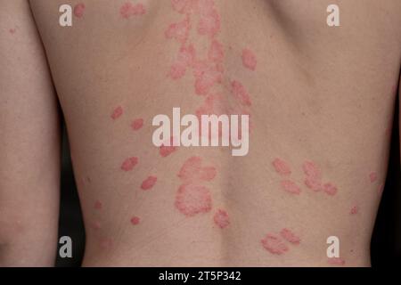 Psoriasis vulgaris, Hautflecken sind in der Regel rot, juckend und schuppig. Stockfoto