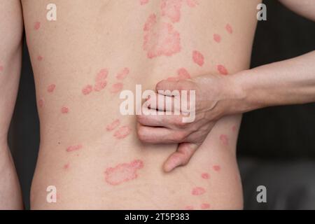 Psoriasis vulgaris, Hautflecken sind in der Regel rot, juckend und schuppig. Stockfoto