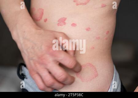 Psoriasis vulgaris, Hautflecken sind in der Regel rot, juckend und schuppig. Stockfoto