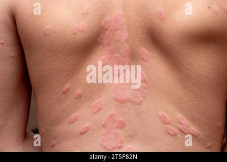 Psoriasis vulgaris, Hautflecken sind in der Regel rot, juckend und schuppig. Stockfoto