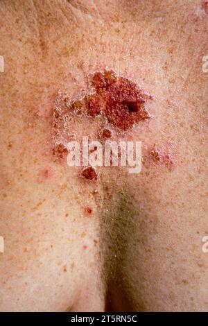 Oberflächliches Basalzellkarzinom, das auf Imiquimod-Creme-Medikation reagiert, nach konsequenter Behandlung mit roter Läsion auf der 30er Jahre kaukasischen weiblichen Brust. Stockfoto