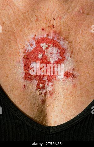 Oberflächliches Basalzellkarzinom, das auf Imiquimod-Creme-Medikation reagiert, nach konsequenter Behandlung mit roter Läsion auf der 30er Jahre kaukasischen weiblichen Brust. Stockfoto