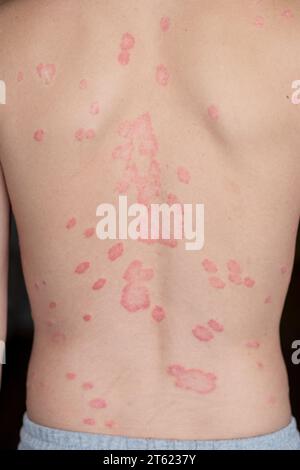 Psoriasis vulgaris, Hautflecken sind in der Regel rot, juckend und schuppig. Stockfoto