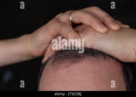 Psoriasis vulgaris, Hautflecken sind in der Regel rot, juckend und schuppig. Stockfoto