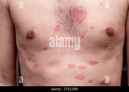 Psoriasis vulgaris, Hautflecken sind in der Regel rot, juckend und schuppig. Stockfoto
