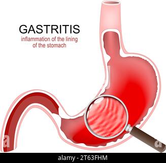 Gastritis. Magenentzündung. Gastrointestinale Störungen. Querschnitt eines menschlichen Magens und Entzündung der Magenschleimhaut Stock Vektor
