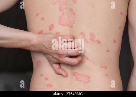 Psoriasis vulgaris, Hautflecken sind in der Regel rot, juckend und schuppig. Stockfoto