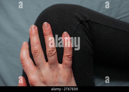 Nahaufnahme von Chilblainen an der Fingerhand einer Person mit Raynaud-Phänomen und Chilblainsläsionen an Fingern Perniosis Red geschwollene Finger Stockfoto