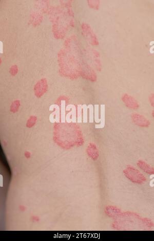 Psoriasis vulgaris, Hautflecken sind in der Regel rot, juckend und schuppig. Stockfoto