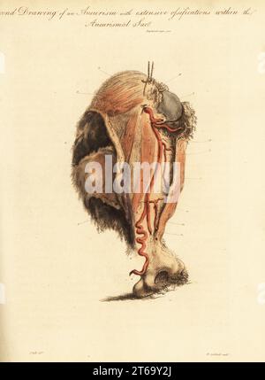 Aneurysmatumor aus gebrochenem Arm einer Frau, die von Pferd und Wagen niedergeschlagen wurde, 1815. Zweite Zeichnung von Aneurismus und ausgedehnten Verknöcherungen mit dem Aneurysacksack. Oberarmknochen 1 und 2 unten, Sack 3, Coraco brachialis a, Bizeps b und Muskeln deltoideus c, Arterien f-m und Vena basilica 7 gestreckt über den Sack. Handkolorierter Kupferstich von William Archibald nach einer Illustration von John Bell aus seinen eigenen Prinzipien der Chirurgie, wie sie sich auf Wunden, Ulzera und Fisteln beziehen, Longman, Hurst, Rees, Orme und Brown, London, 1815. Stockfoto