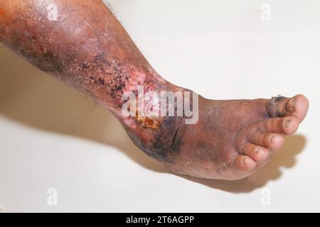 Nahaufnahme der Beine einer Frau mit chronischer Psoriasis auf weißem Hintergrund. Nahaufnahme von Hautausschlag und Schuppenbildung auf der Haut des Patienten. Dermatologisch Stockfoto