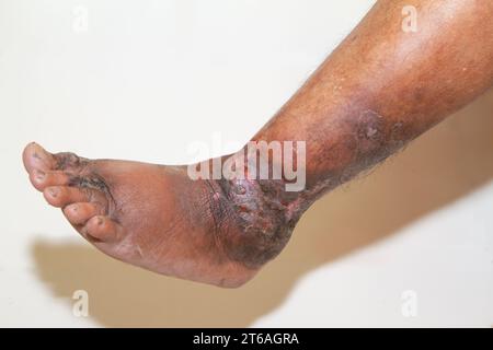 Nahaufnahme der Beine einer Frau mit chronischer Psoriasis auf weißem Hintergrund. Nahaufnahme von Hautausschlag und Schuppenbildung auf der Haut des Patienten. Dermatologisch Stockfoto