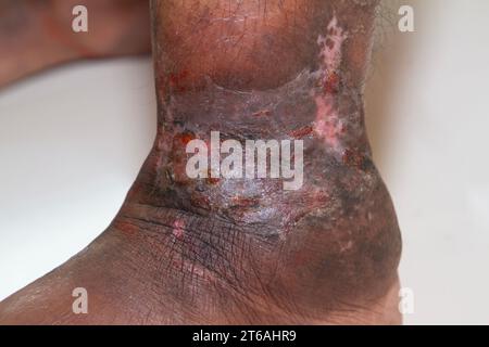 Nahaufnahme der Beine einer Frau mit chronischer Psoriasis auf weißem Hintergrund. Nahaufnahme von Hautausschlag und Schuppenbildung auf der Haut des Patienten. Dermatologisch Stockfoto