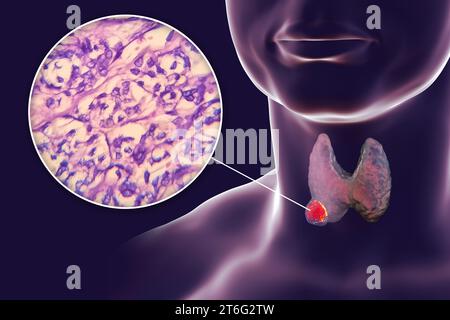 Eine wissenschaftliche 3D-Illustration, die einen menschlichen Körper mit transparenter Haut zeigt und einen Tumor in seiner Schilddrüse zeigt, zusammen mit einem Mikrographbild von t Stockfoto