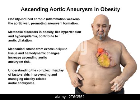 Wissenschaftliche 3D-Illustration, die einen adipösen Mann mit transparenter Haut zeigt und ein aufsteigendes Aortenaneurysma enthüllt, ein Konzept, das die assoziatio hervorhebt Stockfoto