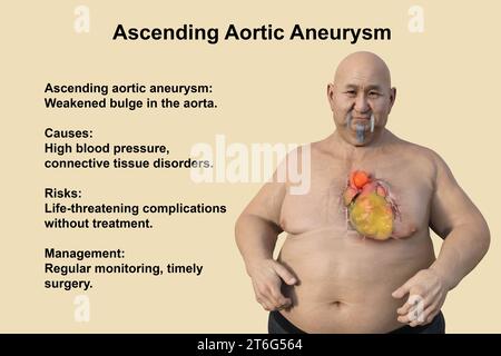 Wissenschaftliche 3D-Illustration, die einen adipösen Mann mit transparenter Haut zeigt und ein aufsteigendes Aortenaneurysma enthüllt, ein Konzept, das die assoziatio hervorhebt Stockfoto