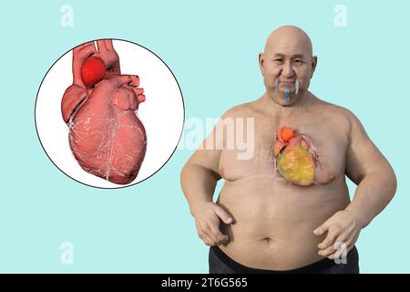 Wissenschaftliche 3D-Illustration, die einen adipösen Mann mit transparenter Haut zeigt und ein aufsteigendes Aortenaneurysma enthüllt, ein Konzept, das die assoziatio hervorhebt Stockfoto