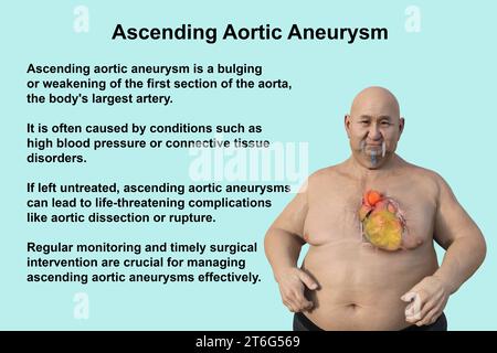 Wissenschaftliche 3D-Illustration, die einen adipösen Mann mit transparenter Haut zeigt und ein aufsteigendes Aortenaneurysma enthüllt, ein Konzept, das die assoziatio hervorhebt Stockfoto
