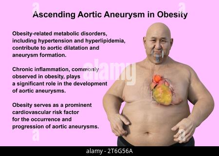 Wissenschaftliche 3D-Illustration, die einen adipösen Mann mit transparenter Haut zeigt und ein aufsteigendes Aortenaneurysma enthüllt, ein Konzept, das die assoziatio hervorhebt Stockfoto