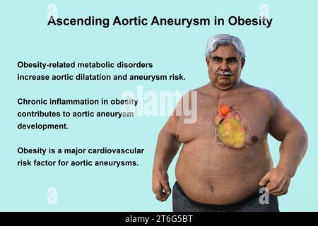 Wissenschaftliche 3D-Illustration, die einen älteren adipösen Mann mit transparenter Haut zeigt und ein aufsteigendes Aortenaneurysma zeigt, ein Konzept, das den Asso unterstreicht Stockfoto