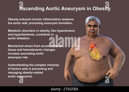 Wissenschaftliche 3D-Illustration, die einen älteren adipösen Mann mit transparenter Haut zeigt und ein aufsteigendes Aortenaneurysma zeigt, ein Konzept, das den Asso unterstreicht Stockfoto